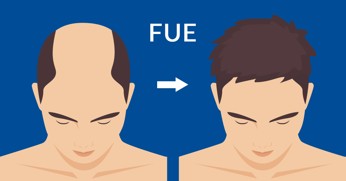 Is the FUE grafting technique invisible and scar-free?